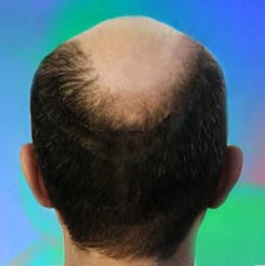 Hair reversal deficiency zinc loss Reversing Seborrheic